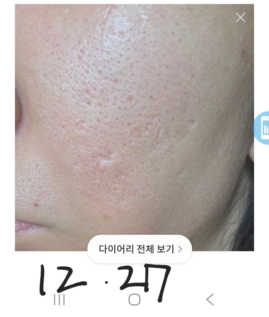 GPT가 알려준 데로 피부루틴이랑 mts 했어...