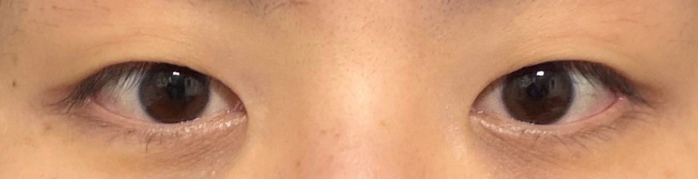 절개쌍수했는데 나랑 안어울리는거같아