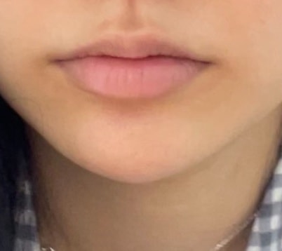 윗입술 필러 할말