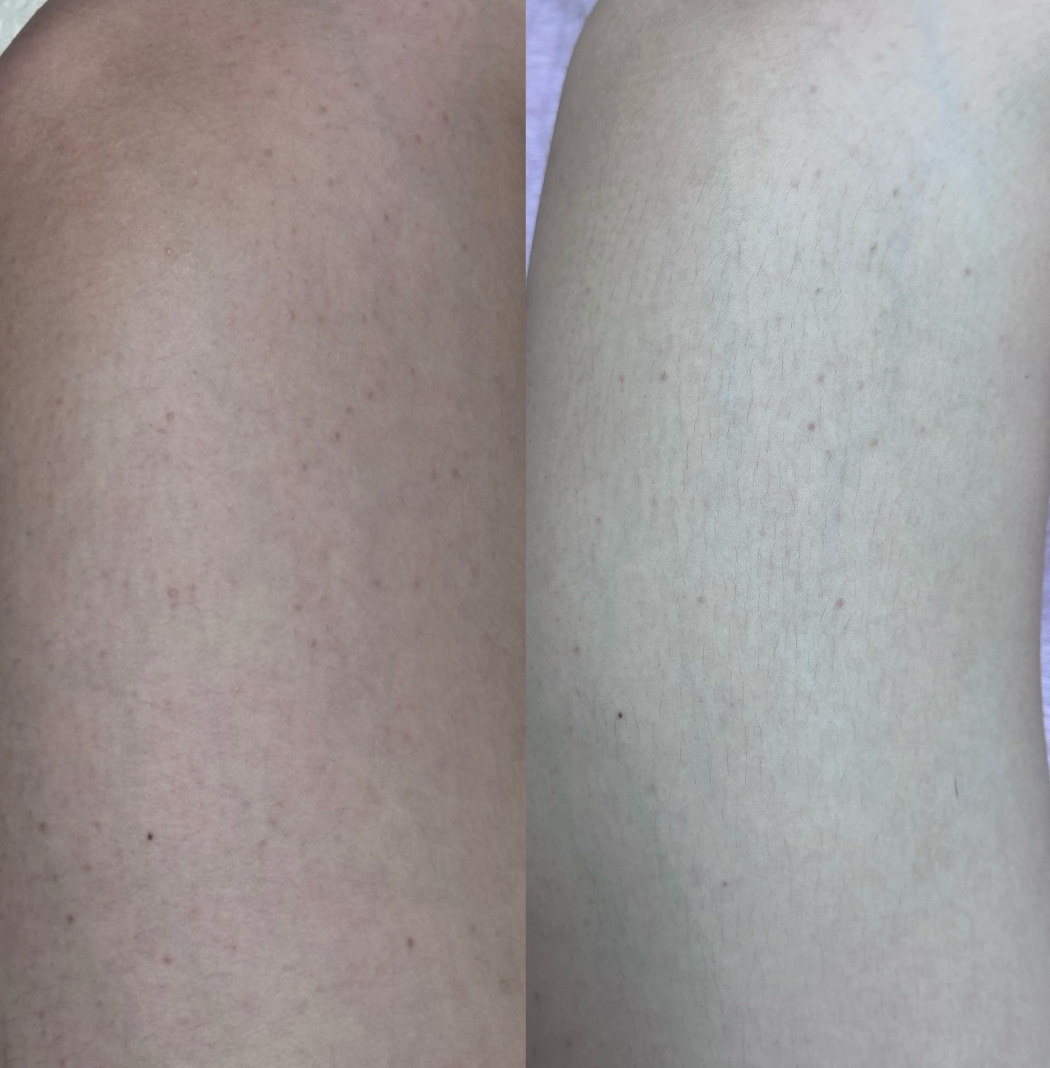 모공각화증 스트레스인 언니들!!!!(사진있음⚠️)