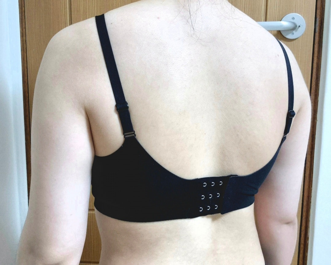 팔뚝 지흡후기 (전후사진있음)