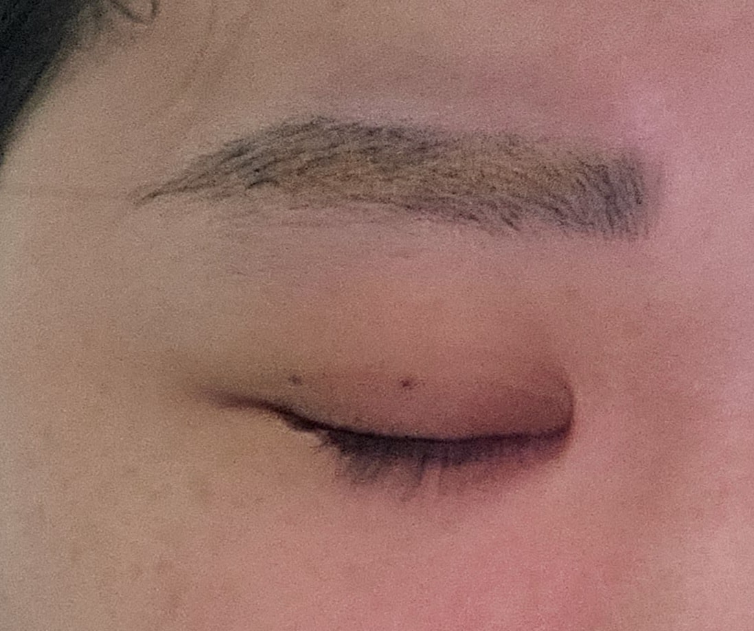 작년에 안검내반이라는 성형을 했어