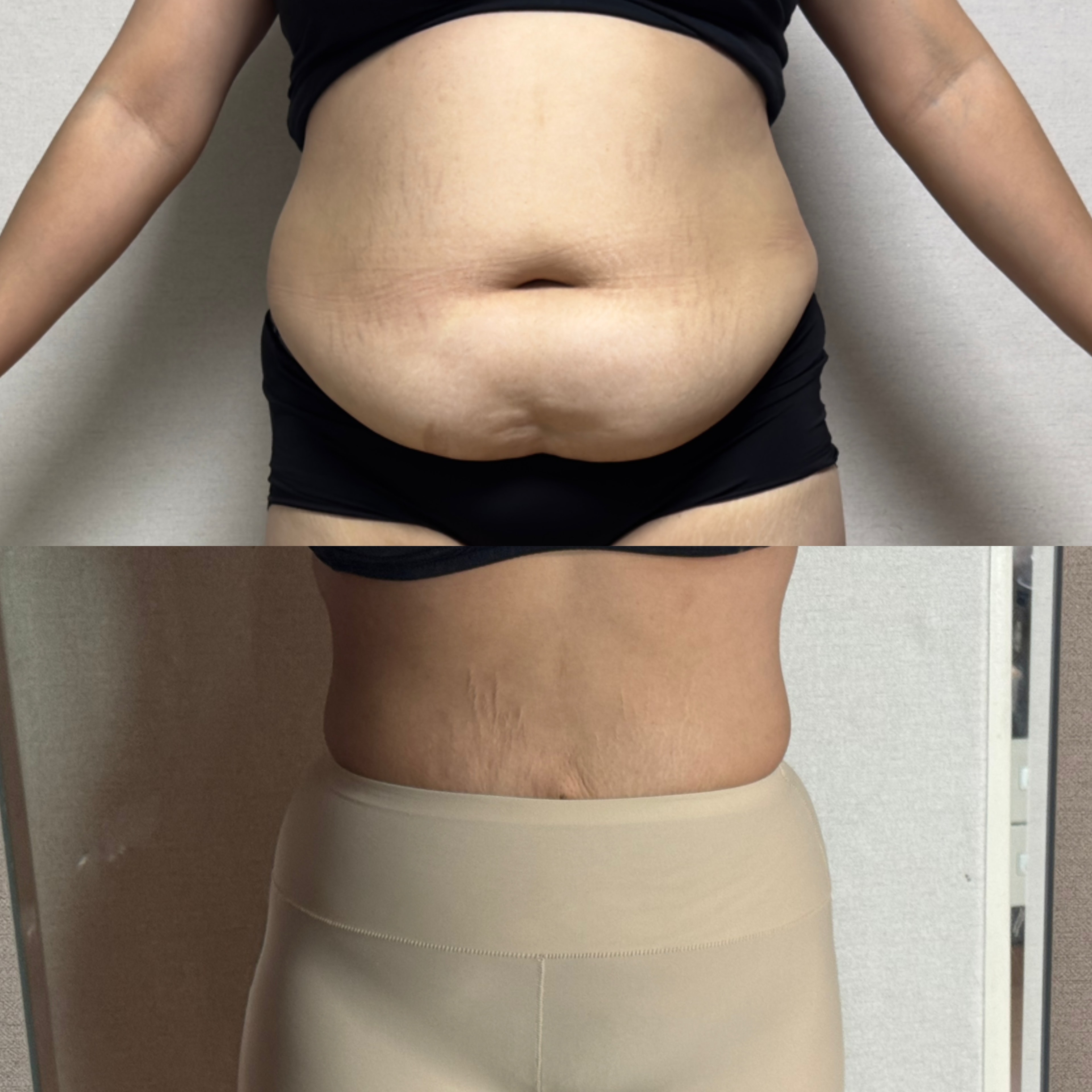 복부 지흡 후 -11kg