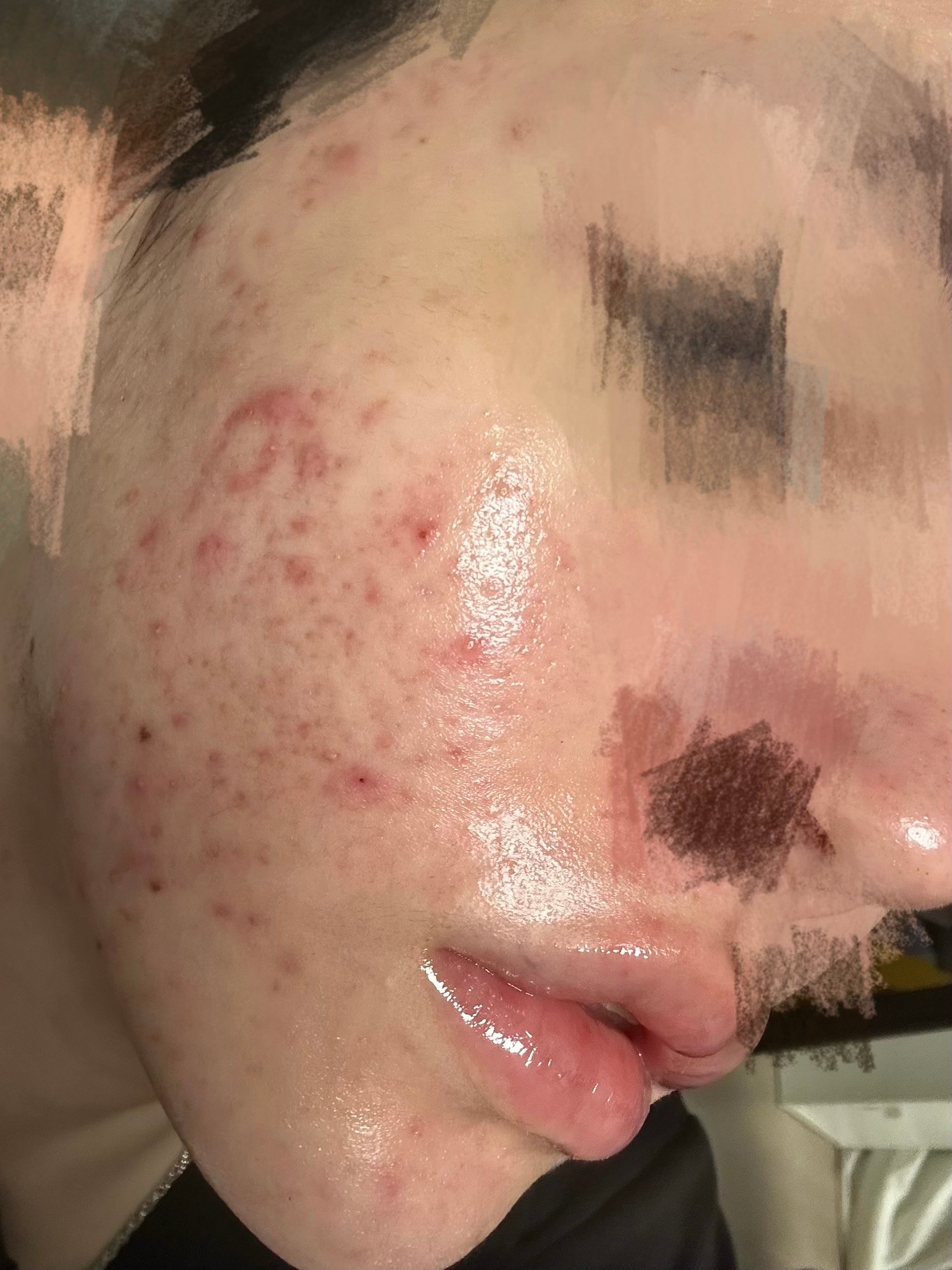 언니들.. 피부 .. 한번만 도와줘 ㅜㅜ(약혐..?