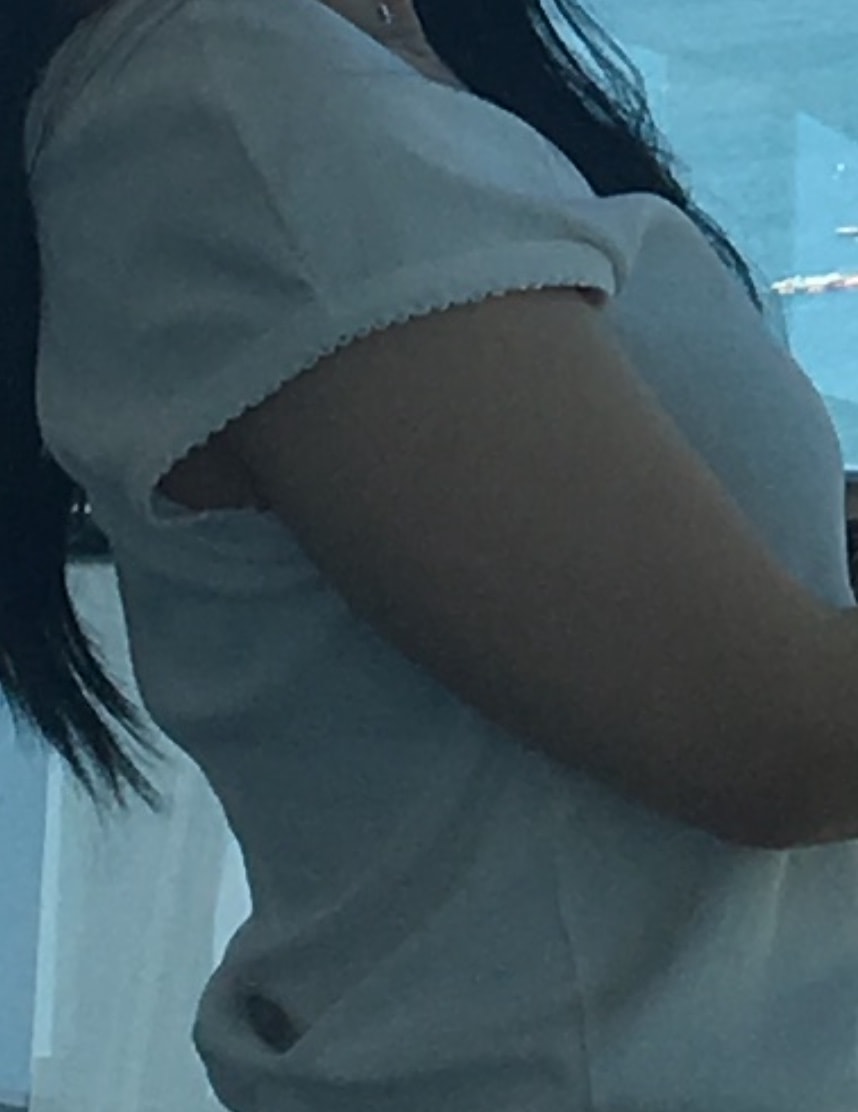 팔뚝 지흡 솔직 후기 (팔 전체+뒷볼록)